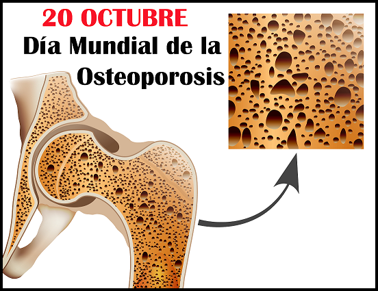 20 de Octubre: Día Mundial de la Osteoporosis